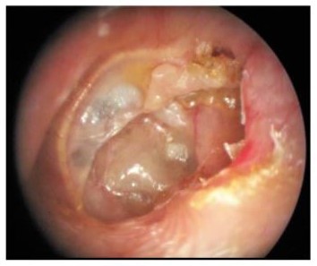 Cirugía del Oído Medio imagen