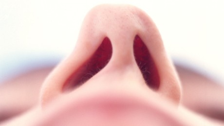 Insuficiencia Respiratoria Nasal Insuficiencia Respiratoria Nasal