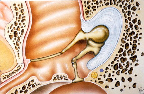 Otitis Media Colesteatomatosa Otitis Media Colesteatomatosa