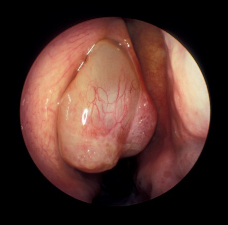 Poliposis Nasal Poliposis Nasal