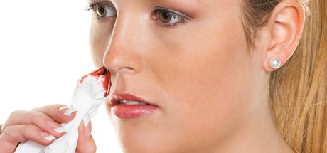 Epistaxis Epistaxis