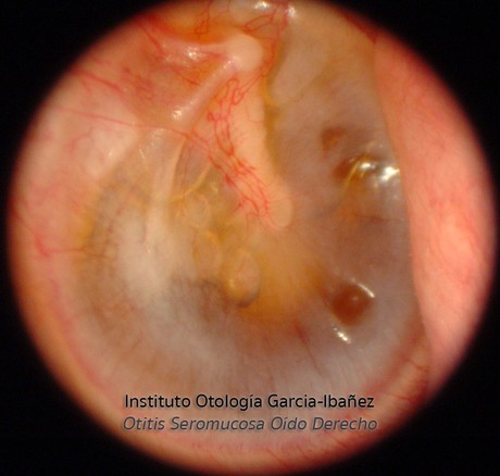 Otitis Seromucosa Otitis Seromucosa