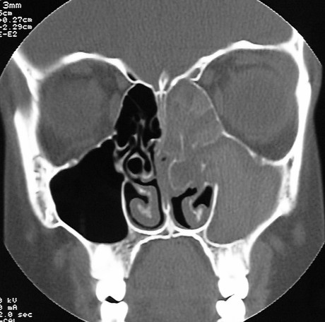 Sinusitis Sinusitis
